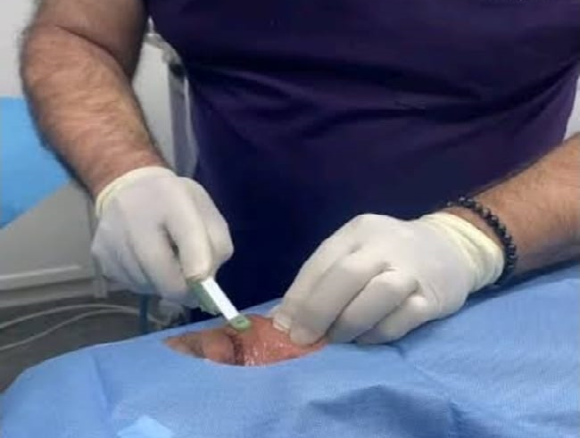 Accutite Uygulaması